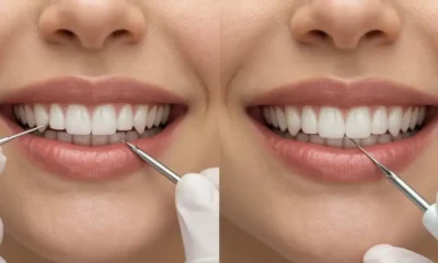 what are composite veneers