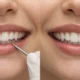 what are composite veneers